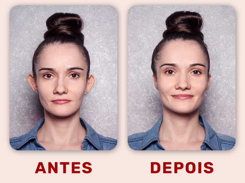Imagem com o rosto de uma mulher antes e depois da otoplastia, mostrando como as orelhas eram antes da cirurgia e como ficaram depois 