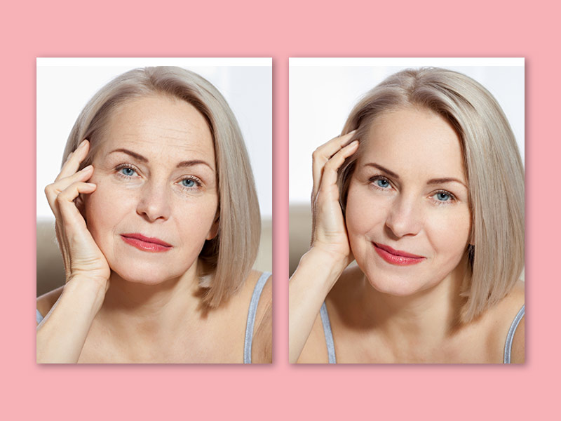 Imagem de uma mulher de meia idade mostrando o antes e depois do botox no rosto