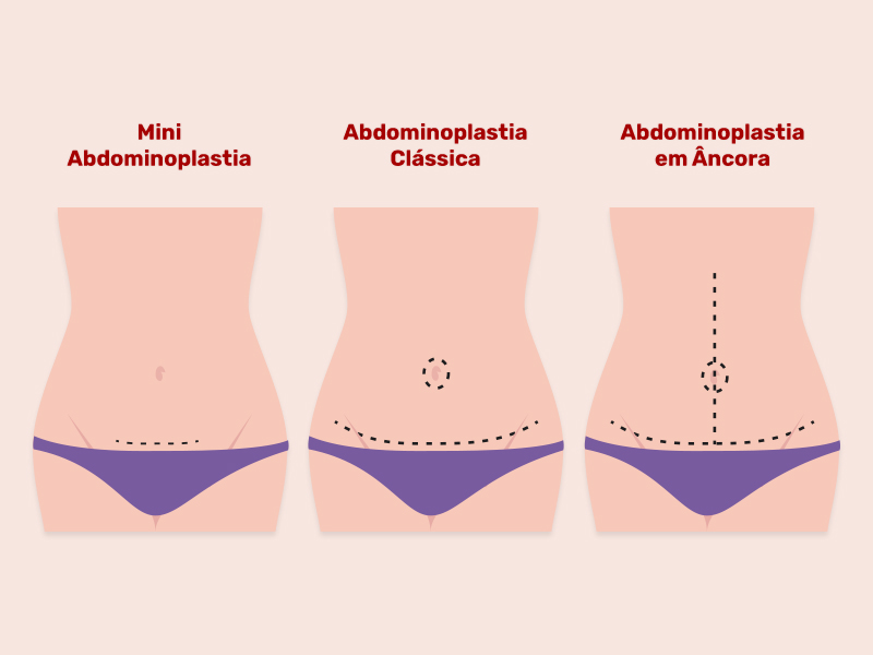 Ilustração com os diferentes tipos de incisão da cirurgia de retirada de pele da barriga, mostrando a mini, a clássica e a em âncora