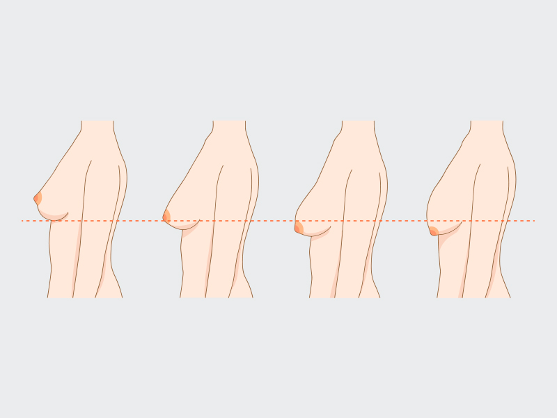 ilustraçao com os 4 graus da ptose mamária