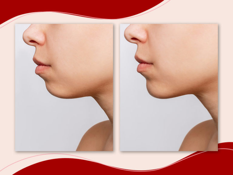 Mentoplastia: o que é, antes e depois, preço, recuperação e tipos
