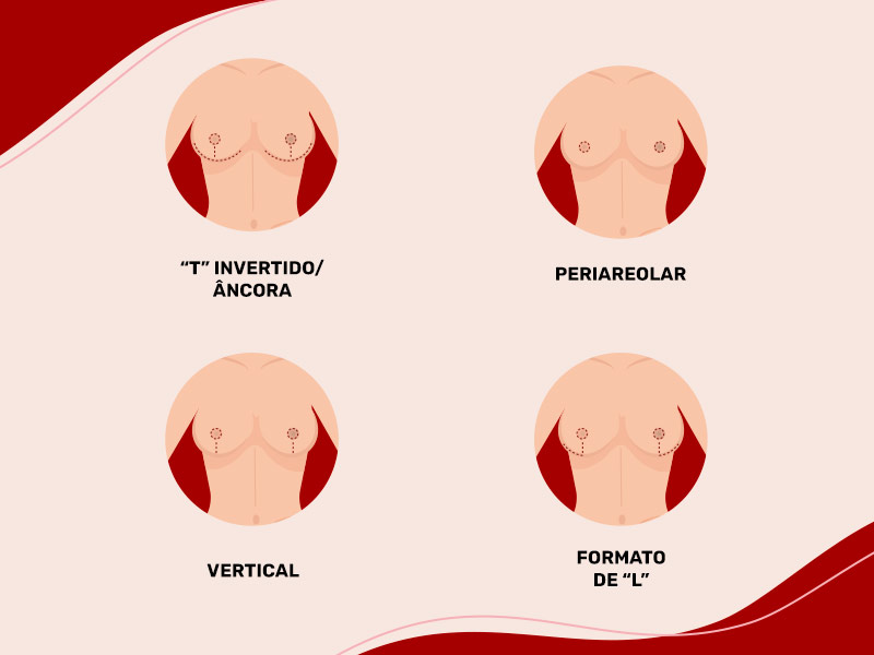 Ilustração que mostra os 4 tipos de cicatriz na mastopexia, T invertido, periareolar, vertical e em L