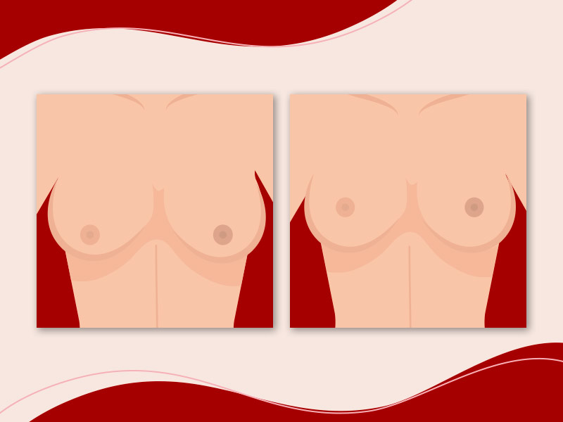 Ilustração que mostra o antes e depois da pexia mamária