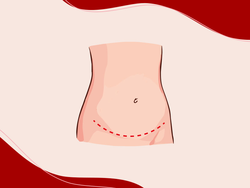 Ilustração onde fica a marca da incisão da abdominoplastia clássica