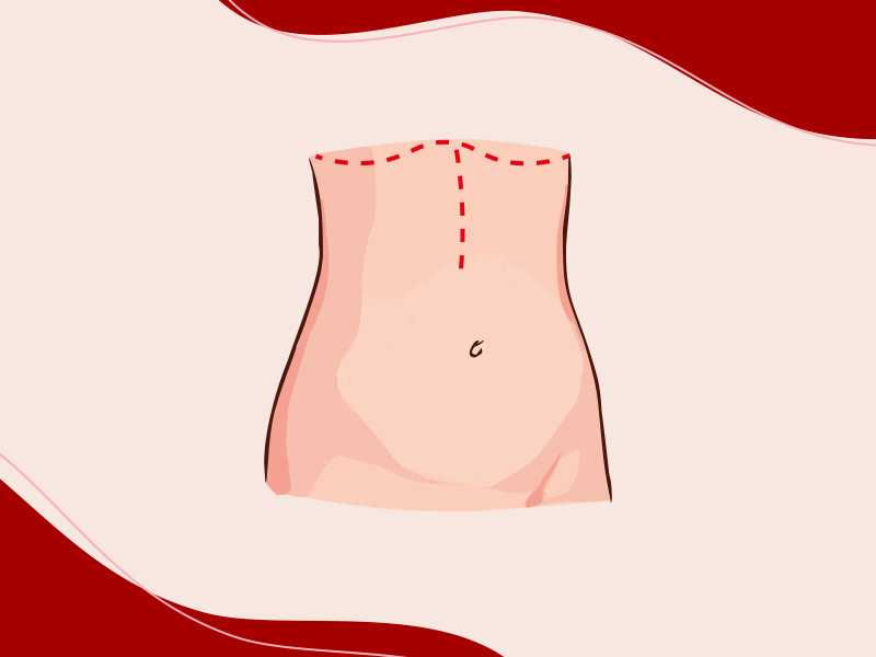 Ilustração onde fica a marca da incisão da abdominoplastia reversa