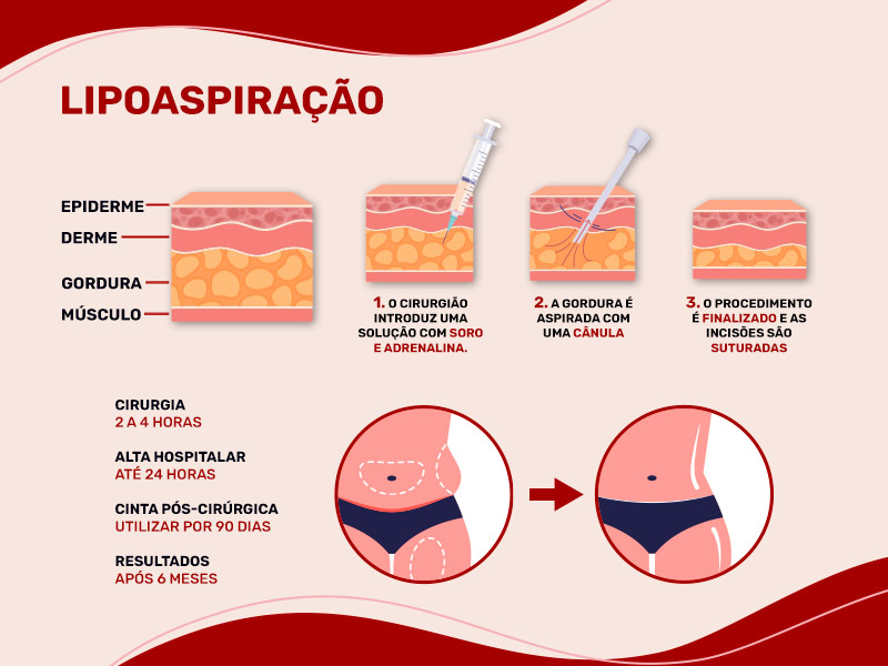 Infográfico com o passo a passo da cirurgia de lipoaspiração