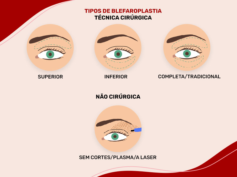 Ilustração mostrando os diferentes tipos de blefaroplastia, cirúrgica e não cirúrgica