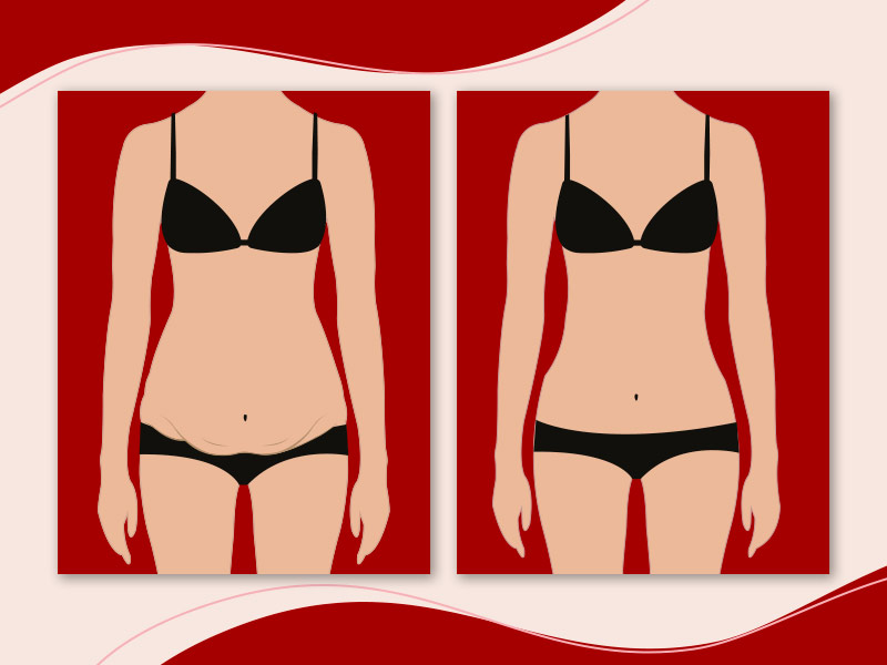 Ilustração de um antes e depois da cirurgia de barriga