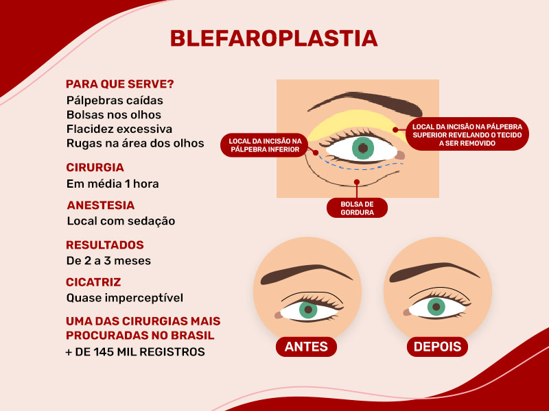 Ilustração mostrando o passo a passo da cirurgia nas pálpebras