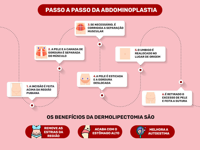Infográfico mostrando o passo a passo da Abdominoplastia