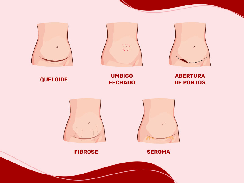 Ilustração com os riscos da Abdominoplastia