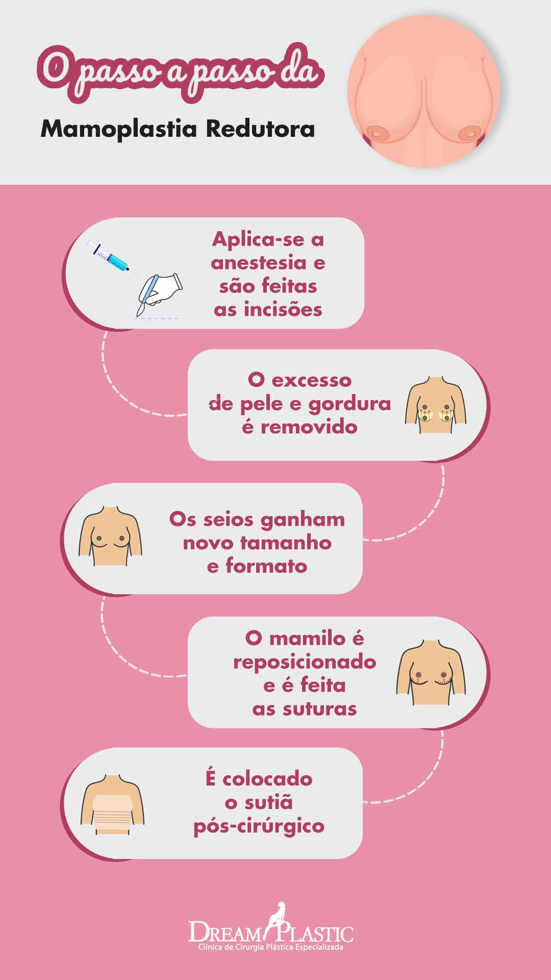 Infográfico com o passo a passo da cirurgia de mamoplastia redutora, da anestesia até as suturas e a colocação do sutiã pós-cirúrgico