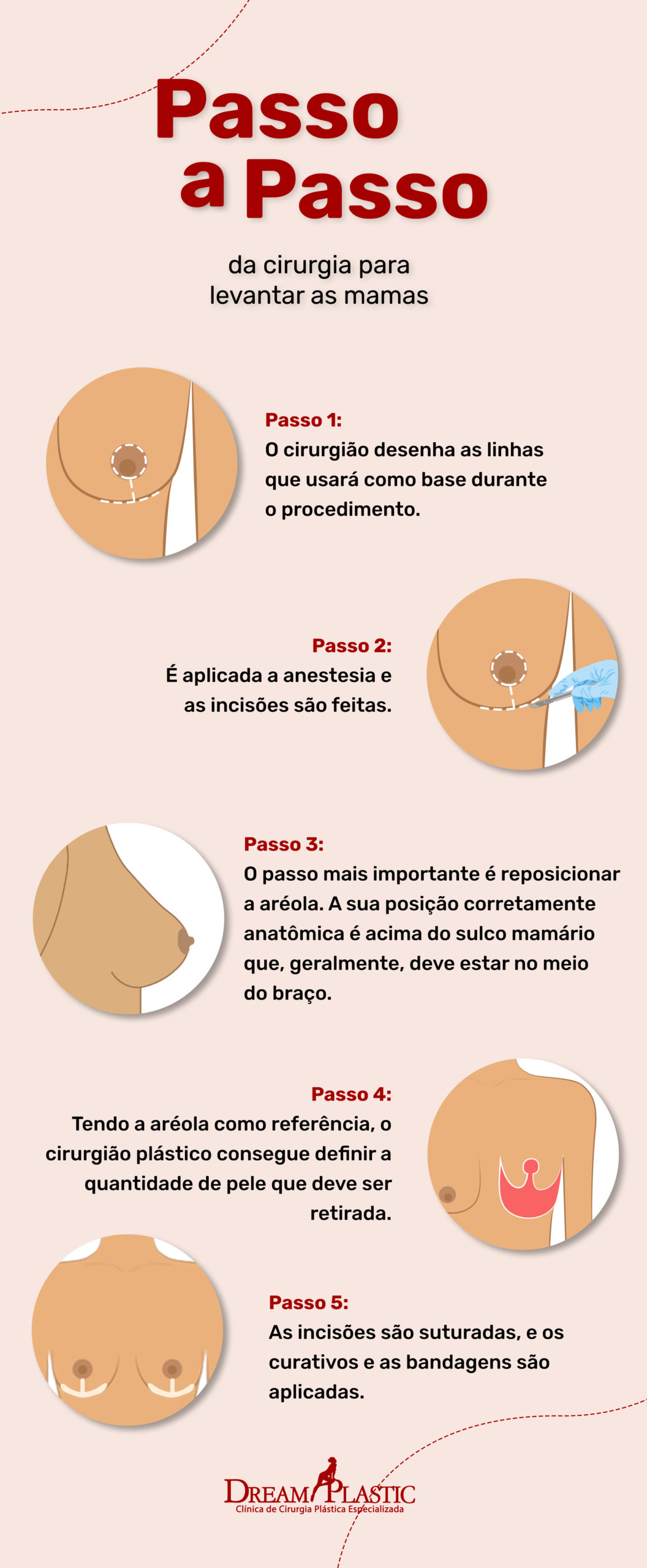 Infográfico que mostra o passo a passo da mastopexia