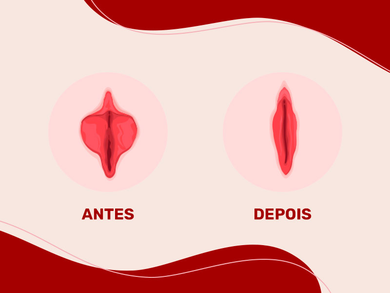 ilustração com o antes e depois de uma cirurgia íntima