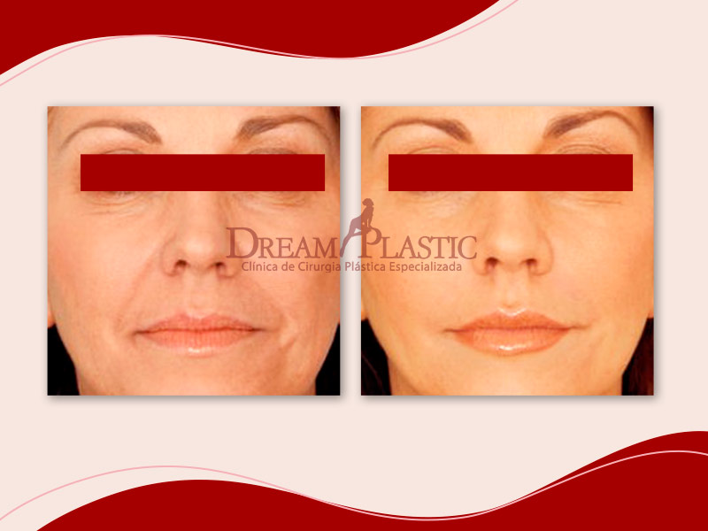 Imagem exemplificando o que é preenchimento facial através de um resultado com antes e depois do procedimento em uma mulher.