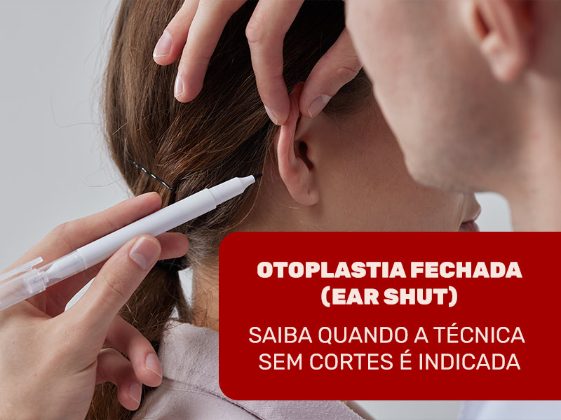 Imagem de paciente realizando uma otoplastia sem cortes, com os seguintes dizeres: Otoplastia Fechada (Ear Shut) saiba quando a técnica sem cortes é indicada