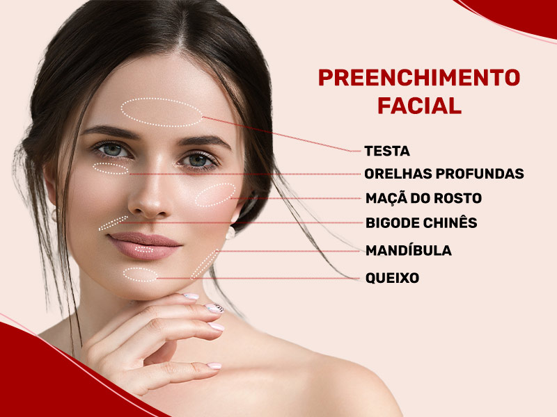 Imagem exemplificando os tipos de preenchimento facial e em quais áreas é possível fazer. Na foto aparece o rosto de uma mulher com marcações nas regiões mais indicadas, que são bigode chinês, lábios, testa, maçã do rosto, queixo, mandíbula e olheiras profundas.