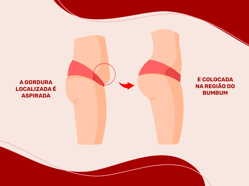 Ilustração exemplificando o processo de lipoenxertia no glúteo, com os seguintes dizeres: a gordura localizada é aspirada e colocada na região do bumbum. 