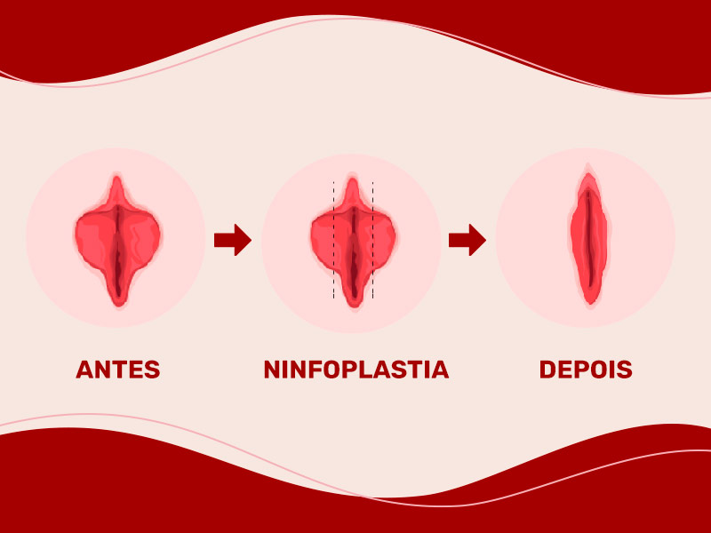 passo a passo da ninfoplastia