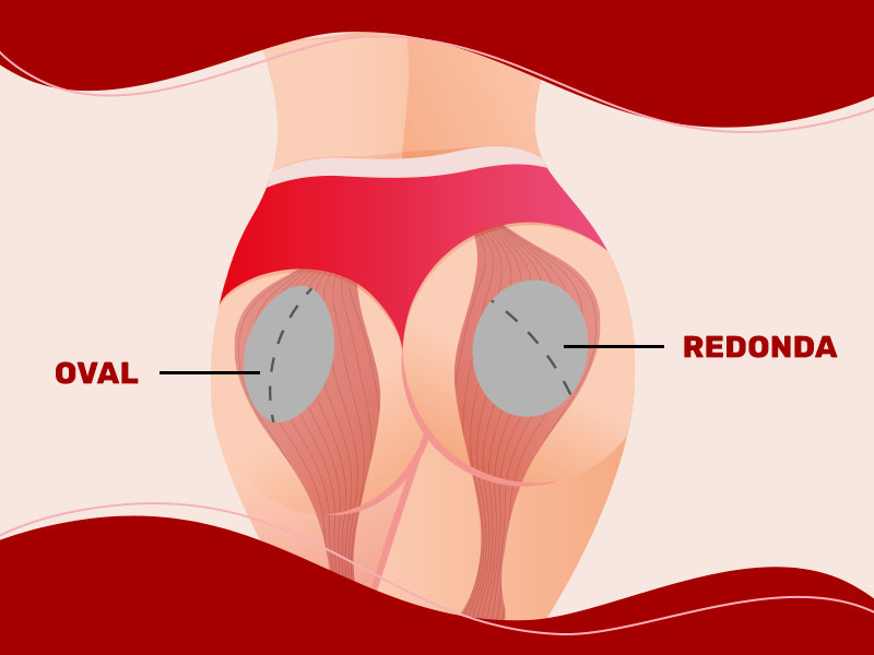 Ilustração mostrando os dois tipos de prótese (oval e redonda) posicionadas nos glúteos femininos