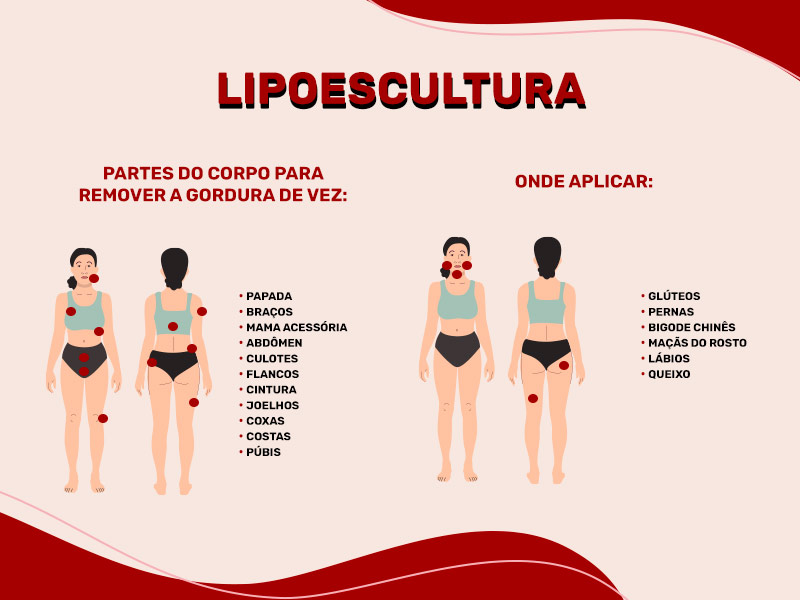 Ilustração mostrando toda as regiões em que é possível fazer lipoescultura, indicando as regiões de onde a gordura pode ser retirada e em quais geralmente é injetada para aumentar o volume. 