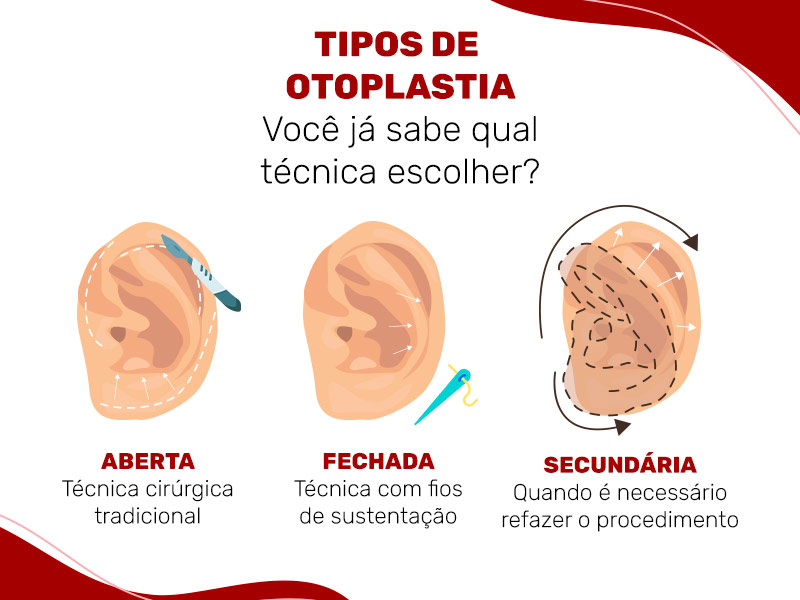 Ilustração com o seguinte título: Tipos de Otoplastia, você sabe qual escolher? Abaixo estão três ilustração que remetem às técnicas de otoplastia aberta (técnica cirúrgica tradicional), fechada (com fios de sustentação) e secundária (quando é necessário refazer o procedimento). 