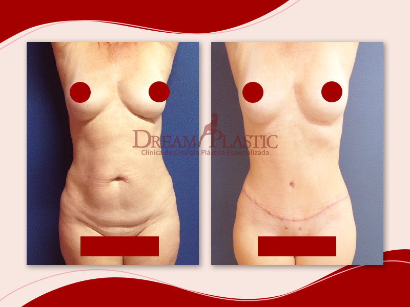 Imagem mostrando o resultado de uma paciente de 50 anos que realizou uma abdominoplastia e lipoescultura. Ela está de frente na foto antes e depois do procedimento.