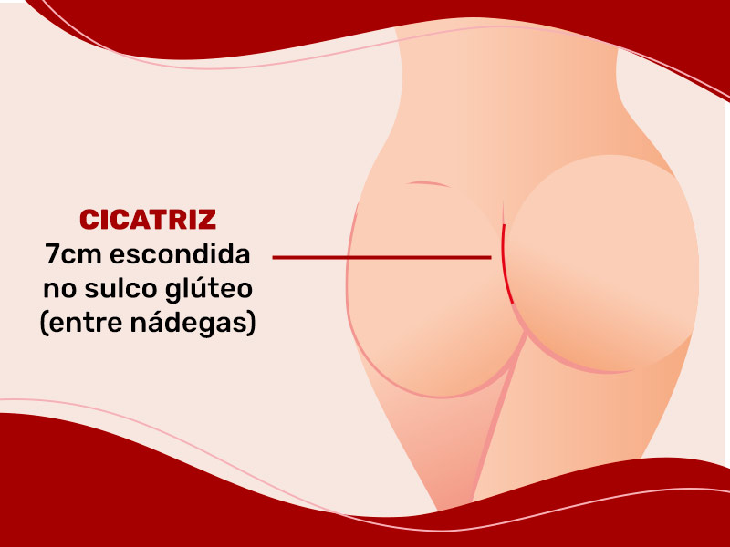 Ilustração mostrando onde fica a cicatriz da cirurgia para aumentar o bumbum, no sulco interglúteo