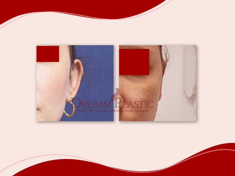 Imagem mostrando como fica o resultado da otoplastia em uma paciente branca, de 32 anos, que realizou a cirurgia para corrigir a orelha de abano.