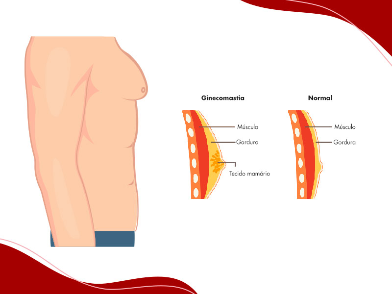 Ilustração que mostra as diferenças estruturais nos seios de um homem normal e um com ginecomastia