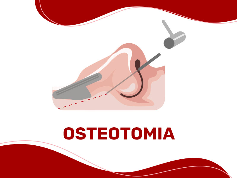 Ilustração de uma osteotomia no nariz