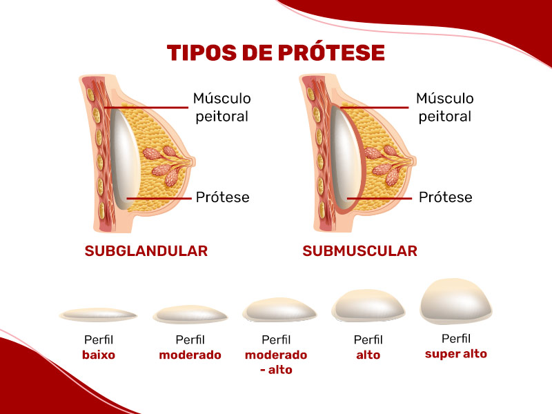 Ilustração que mostra a prótese subglandular, submuscular e os tipos de prótese