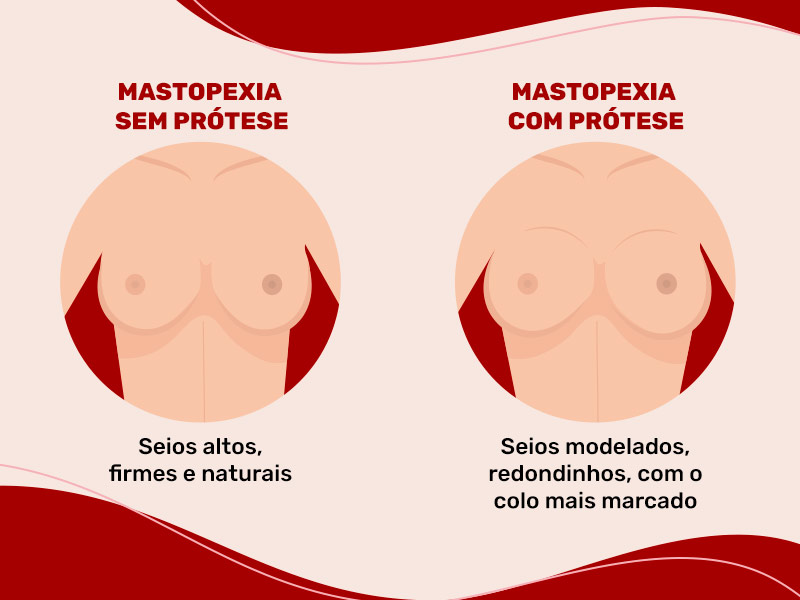 Ilustração que mostra as diferenças no resultado dos seios depois da mastopexia sem prótese e com