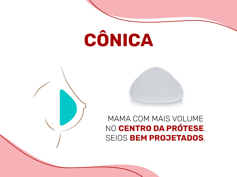 Ilustração mostrando a prótese de silicone cônica dentro do seio