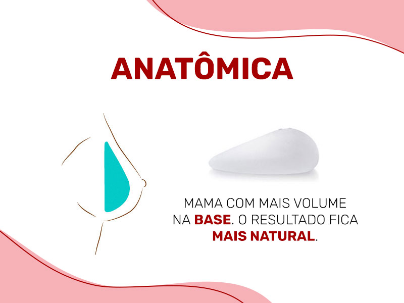 Ilustração mostrando a prótese de silicone gota dentro do seio