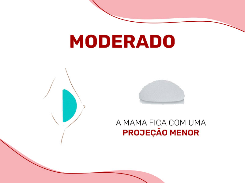 Ilustração mostrando a prótese de silicone perfil moderado dentro do seio