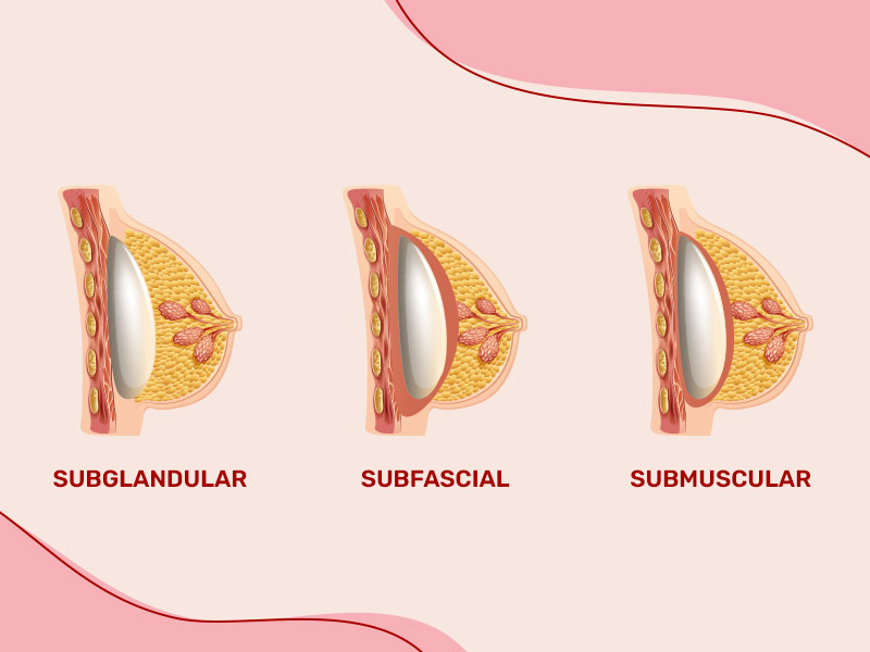 O silicone marcado ou mais natural depende de alguns fatores