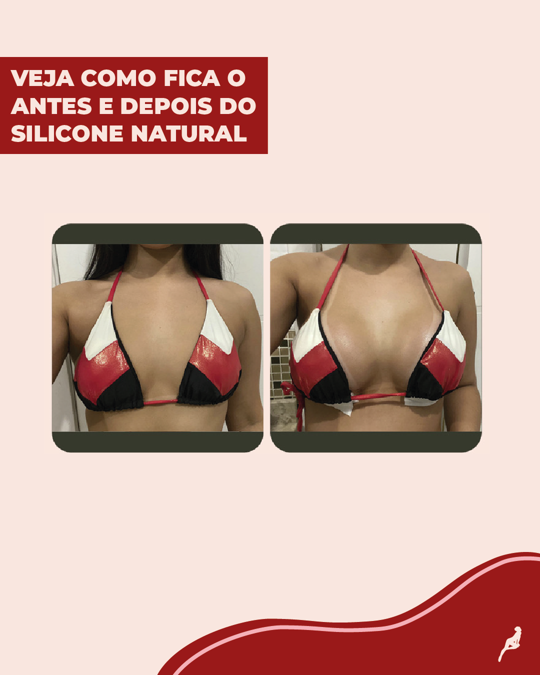 Antes e depois do silicone natural de paciente da Dream Plastic