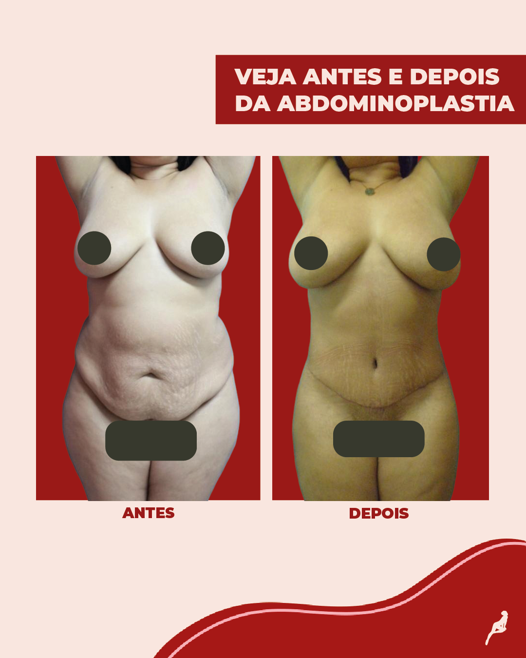 O que é abdominoplastia e para que serve? Antes e depois de uma abdominoplastia, para mostrar o que é o procedimento