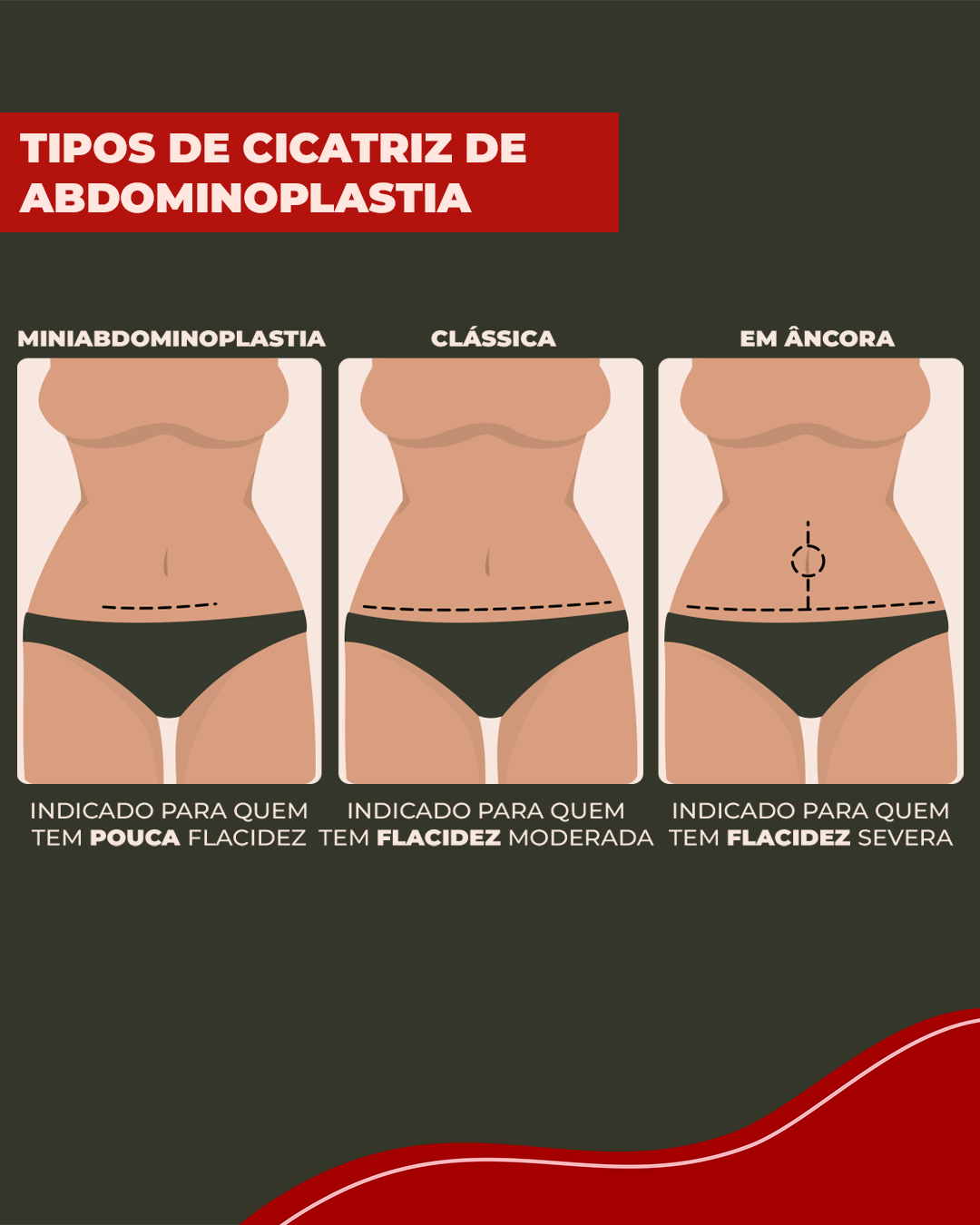 Quais são os tipos de incisão na abdominoplastia? Ilustração que mostra os tipos de cicatriz de abdominoplastia