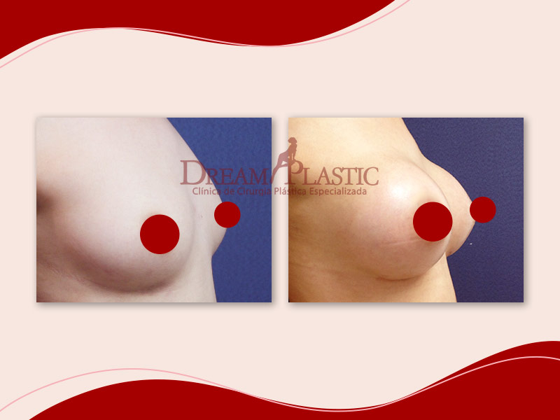 Antes e depois da mamoplastia de aumento Antes e depois da mamoplastia de aumento de paciente da Dream Plastic