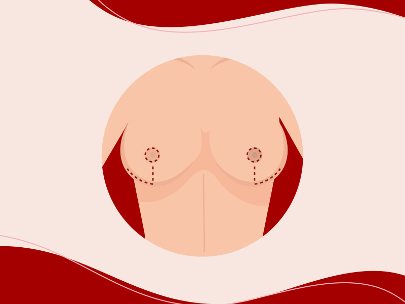 Como é a mastopexia em l? Ilustração que mostra como é a incisão e cicatriz na mastopexia em l