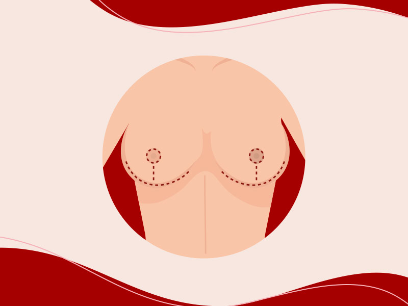 Como é a mastopexia em t invertido? Ilustração que mostra como fica a mastopexia em t invertido