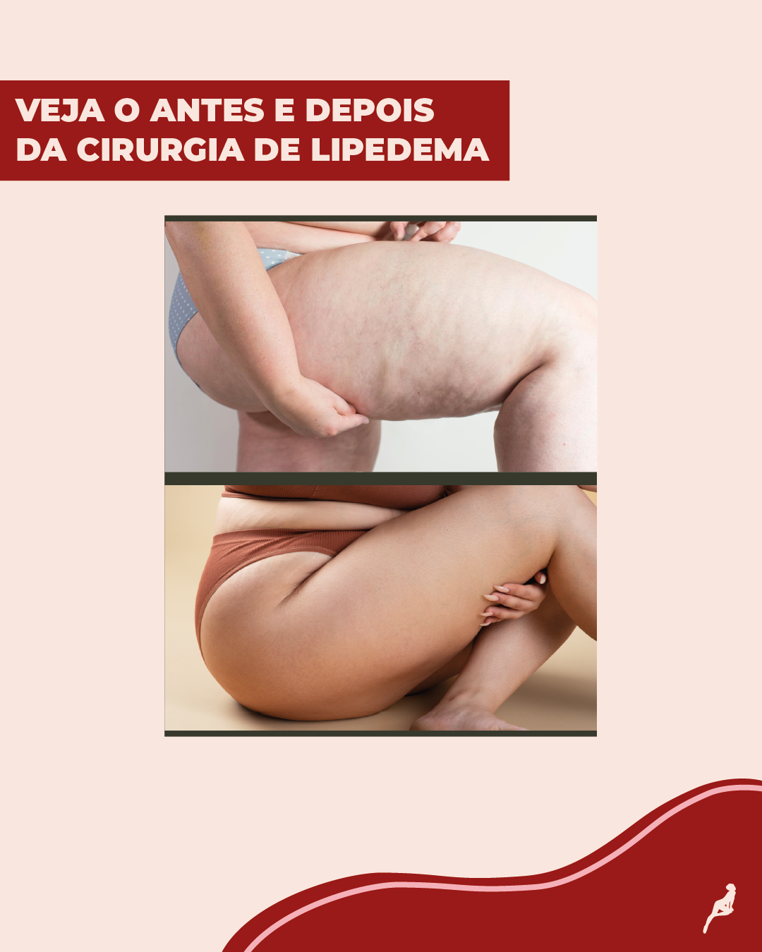Como fica o antes e depois do tratamento de lipedema?