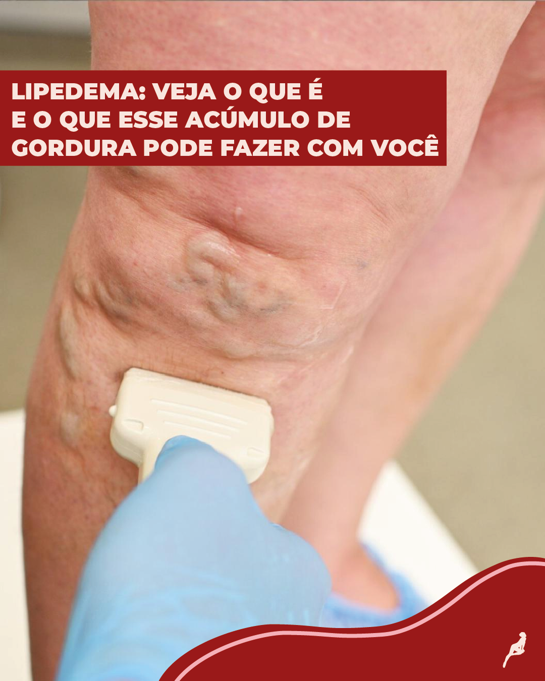 O que é lipedema?