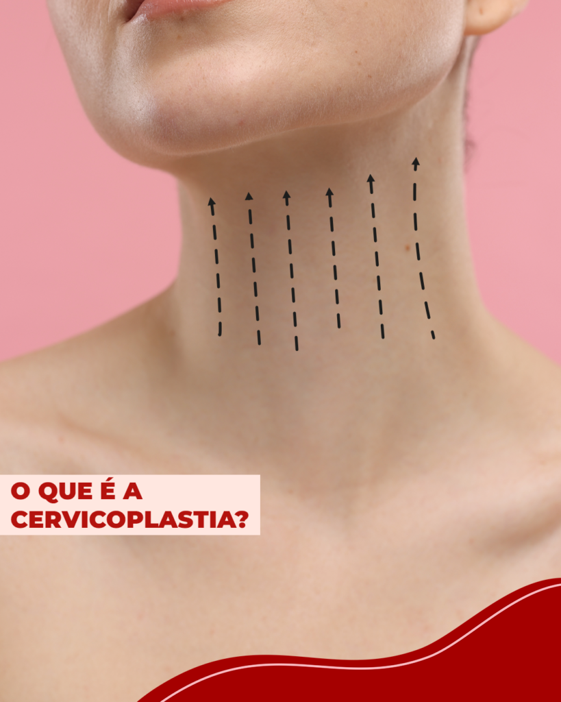 Cervicoplastia: Tudo Sobre a Cirurgia no Pescoço