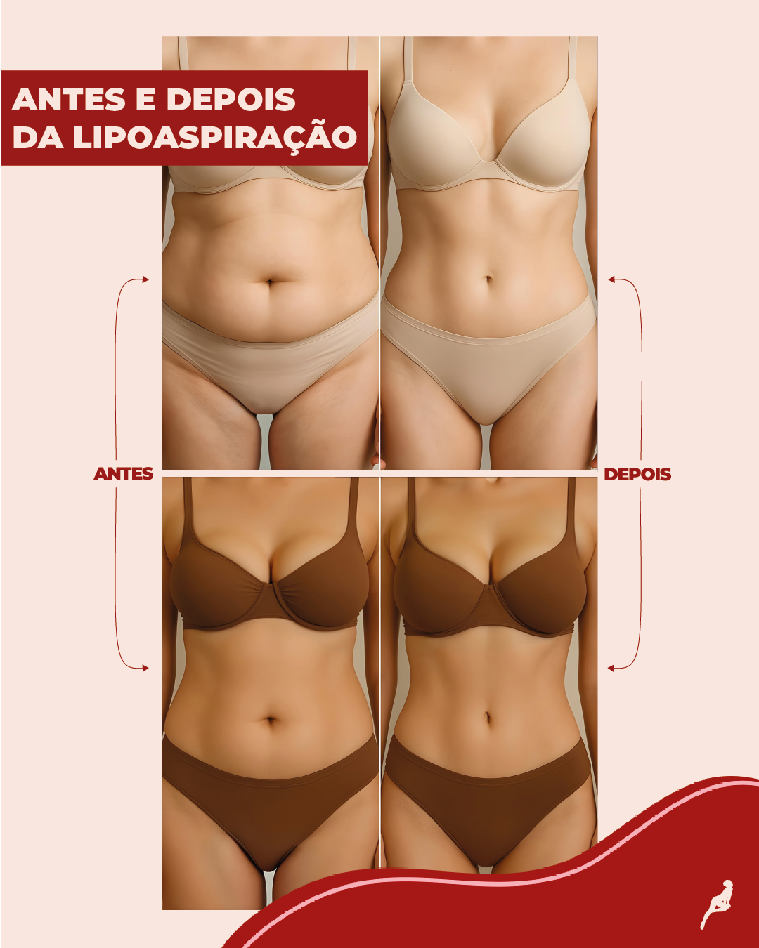 Comparação visual de antes e depois da lipoaspiração em duas pacientes, com redução de gordura no abdômen, cintura e flancos