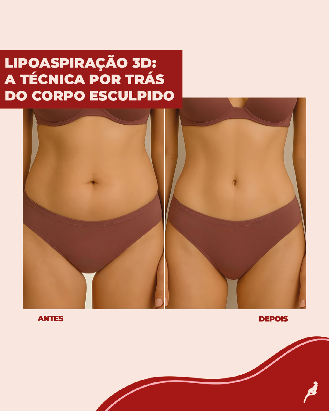 Resultado da lipoaspiração 3D mostrando definição corporal tridimensional em paciente com baixa gordura localizada