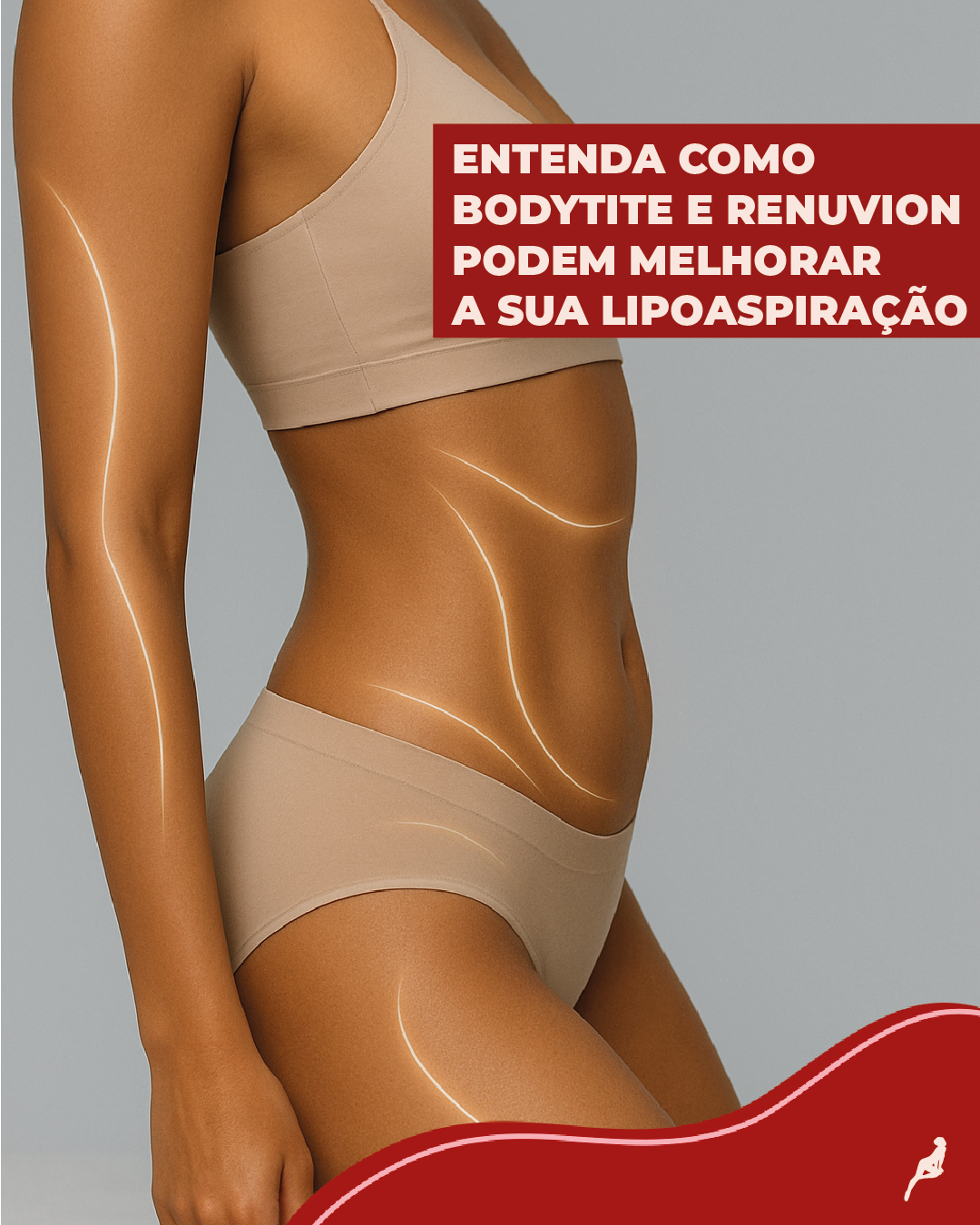 Representação do uso de tecnologias Renuvion e BodyTite para melhorar os resultados da lipoaspiração com foco em retração de pele