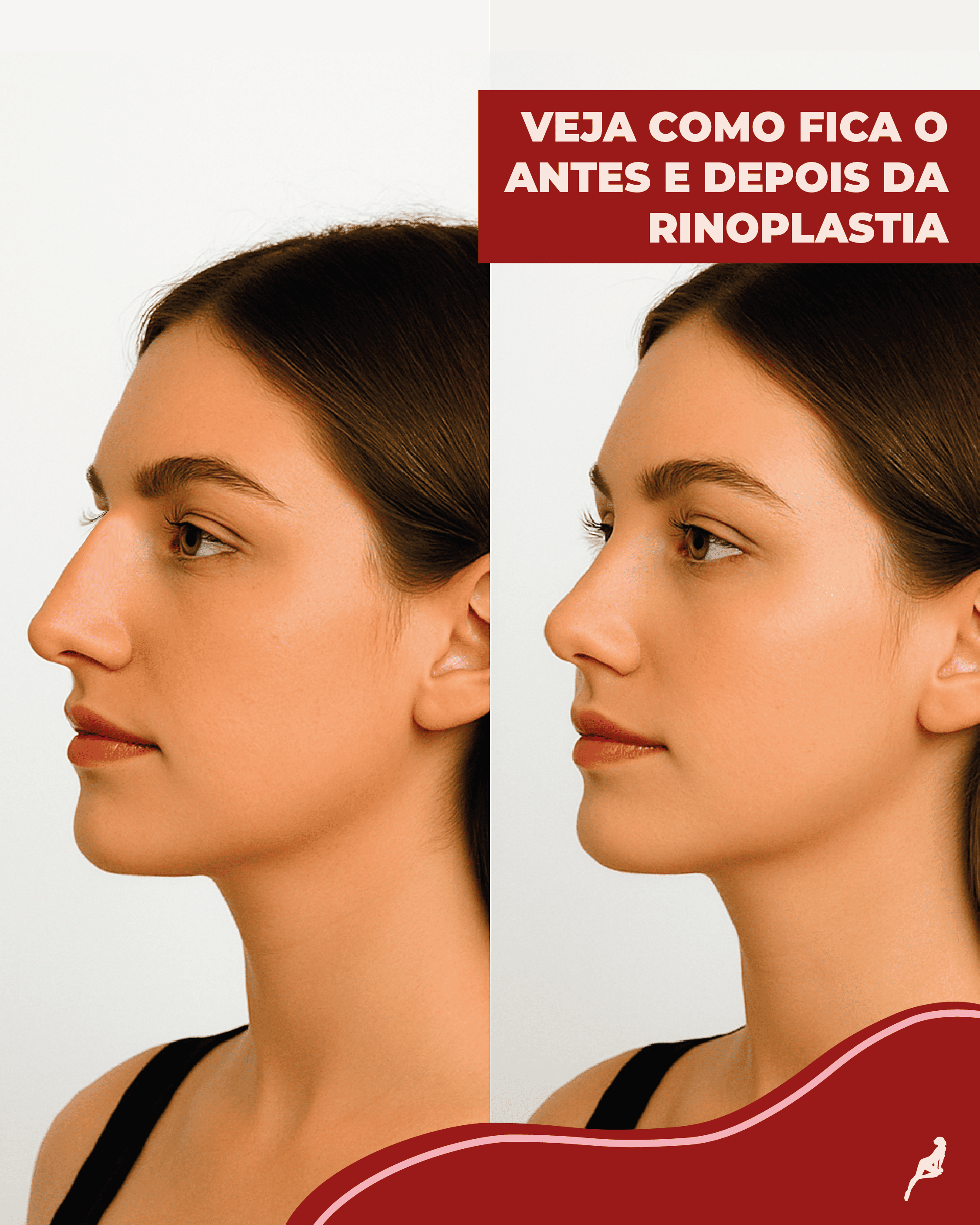 Como fica o antes e depois da rinoplastia? antes e depois da rinoplastia